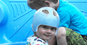 De baby helm als therapie bij een schedelafwijking
